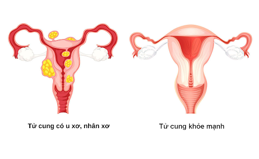 U xơ tử cung và nhân xơ tử cung có bản chất là giống nhau